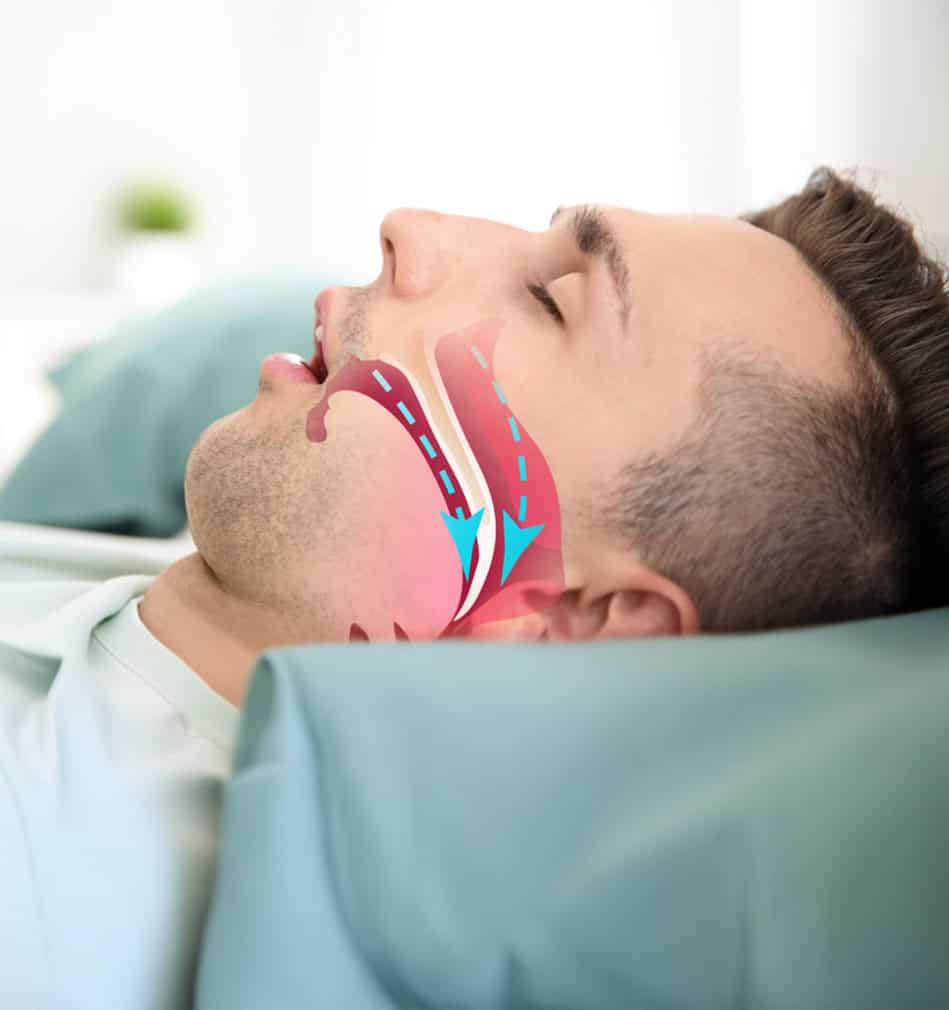 Sleep apnea treatment